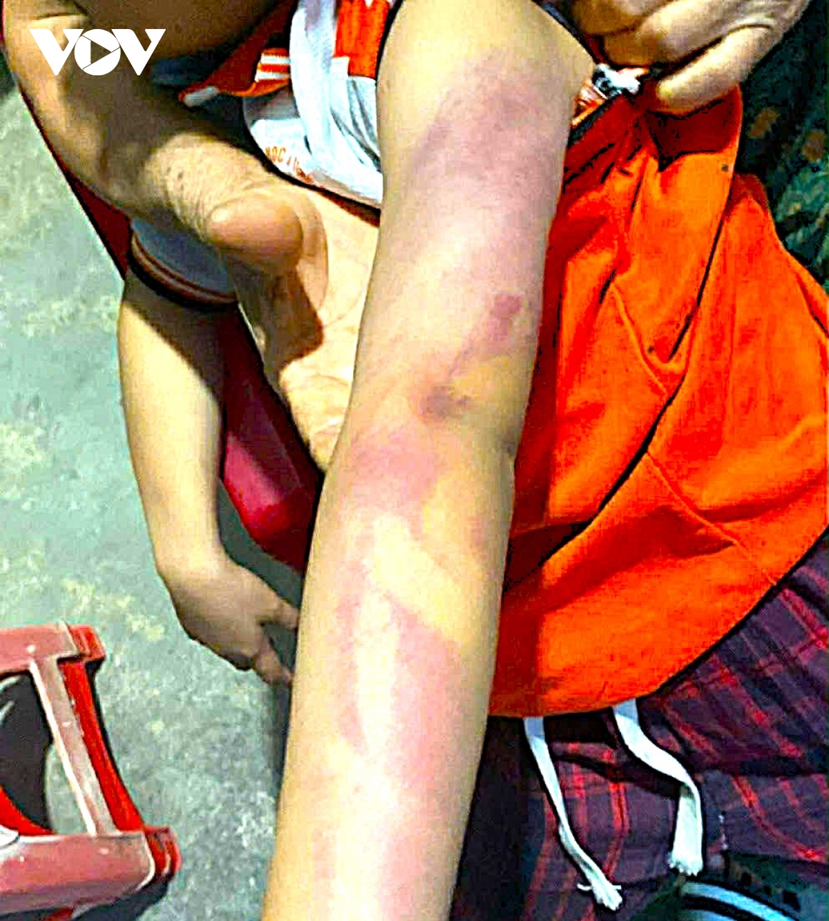 Bé gái lớp 2 ở Hà Tĩnh bị bạn cùng lớp dùng thước đánh bầm tím người